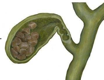 胆结石吃白瓜,白瓜助力健康生活